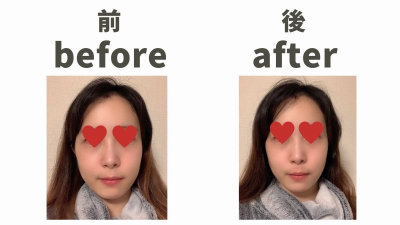 メディリフトを使ったビフォーアフターの写真!